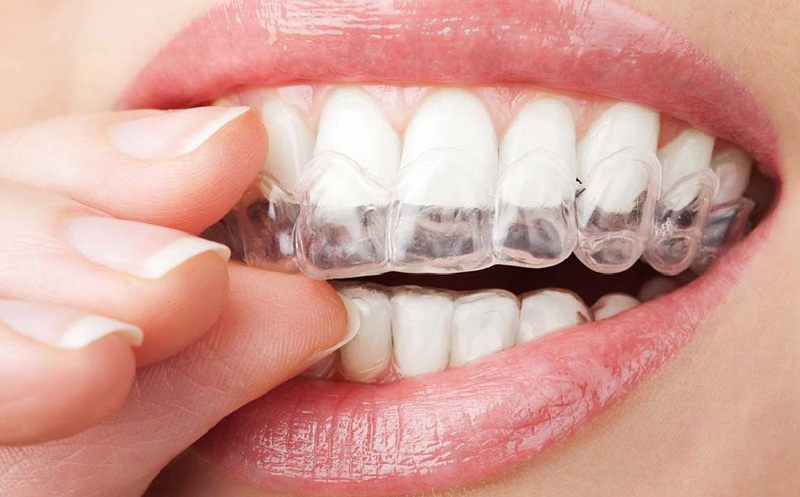 კბილების ქიმიურად გათეთრება კაპებით სახლის პირობებში + საჩუქრად კაპები სტომატოლოგიური კლინიკისგან `Stomus/სტომუსი`