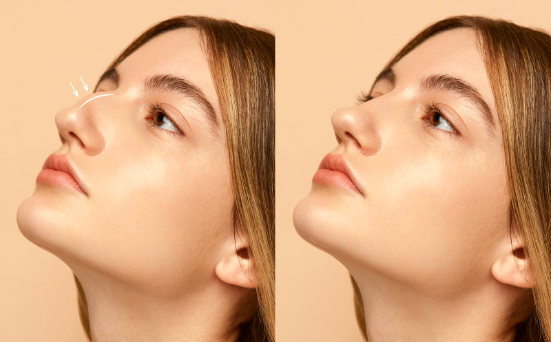 რამდენად რეალურია რინოპლასტიკა ქირურგიული ჩარევის გარეშე?