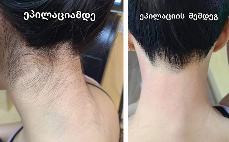 დიოდური ეპილაცია, 3 სხივიანი ლაზერული აპარატით