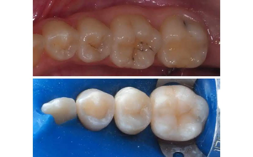 კბილის კარიესის დაბჟენა მაღალი ხარისხის ბჟენით