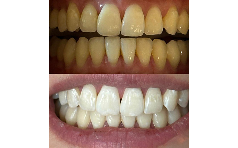 კბილების 4-5 ტონით გათეთრება ZOOM–ის აპარატით