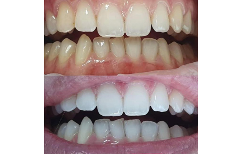 კბილების 4-5 ტონით გათეთრება ZOOM–ის აპარატით